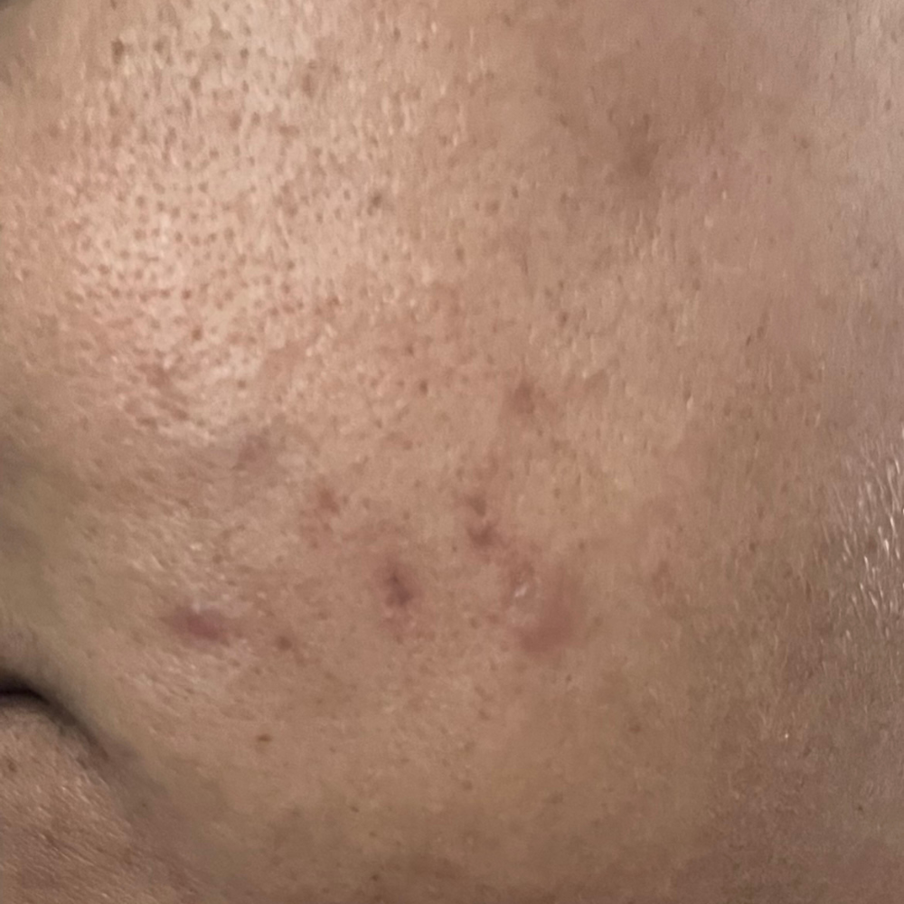 Photo avant traitement des taches avec le sérum TXA Niacinamide de Medicube