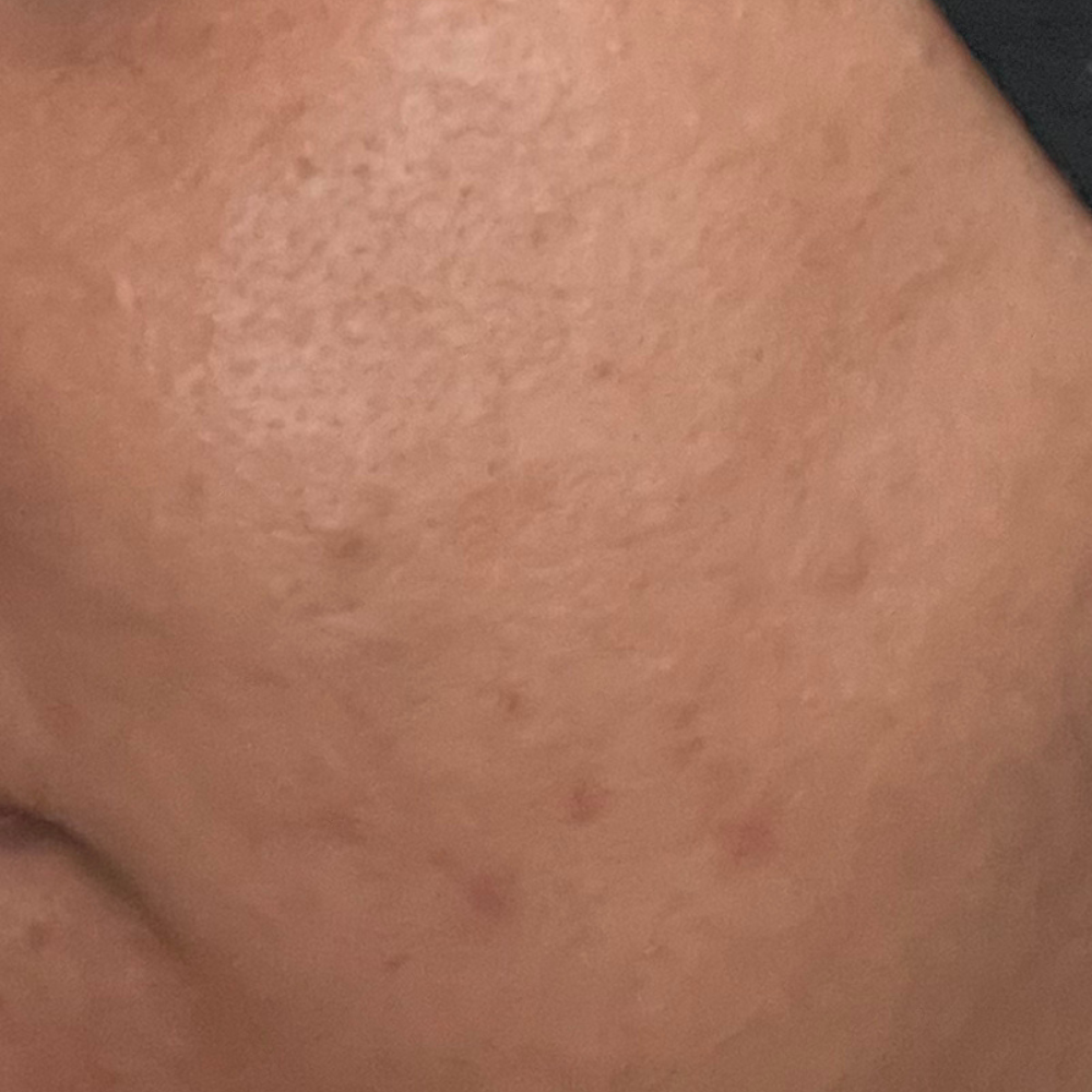 Résultat après 7 jours d’utilisation du sérum TXA Niacinamide de Medicube sur taches pigmentaires et pores